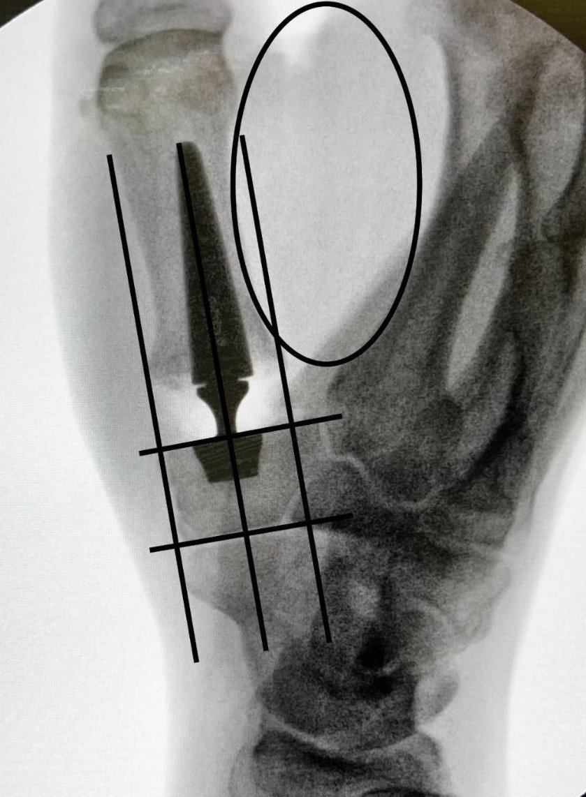 Touch CMC dual mobility prosthesis X-ray in thumb joint