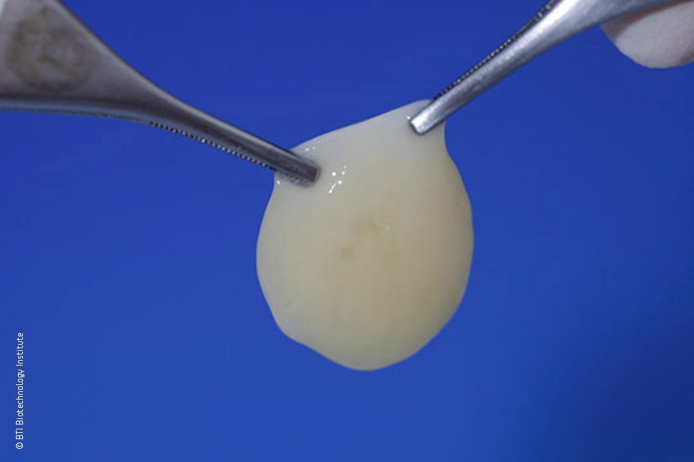 Endoret PRGF fibrin clot held with forceps