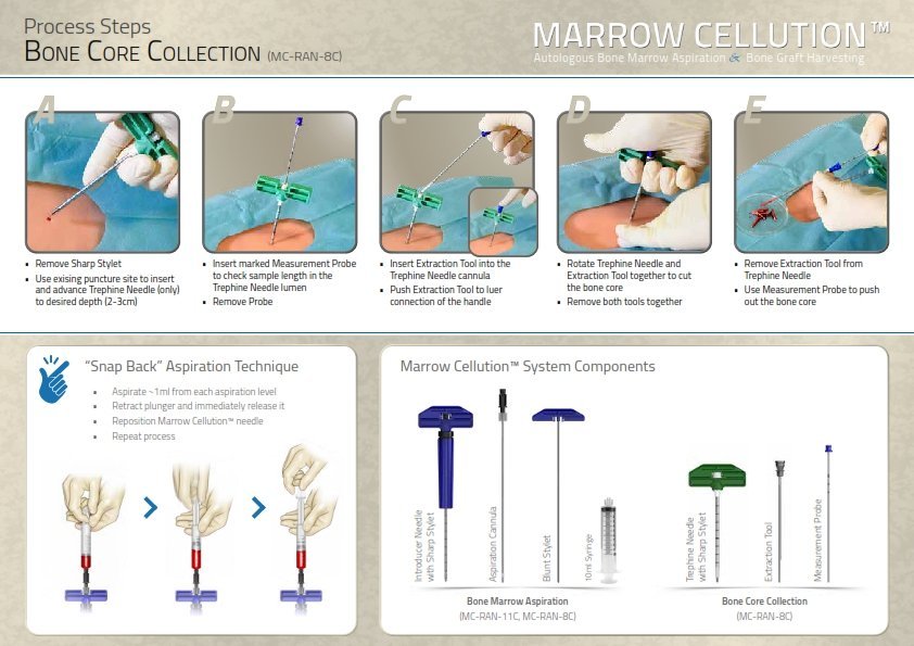 Marrow Cellution bone marrow collection technique
