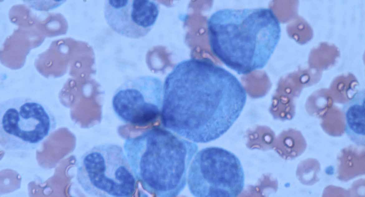 Bone marrow aspirate smear, microscopy