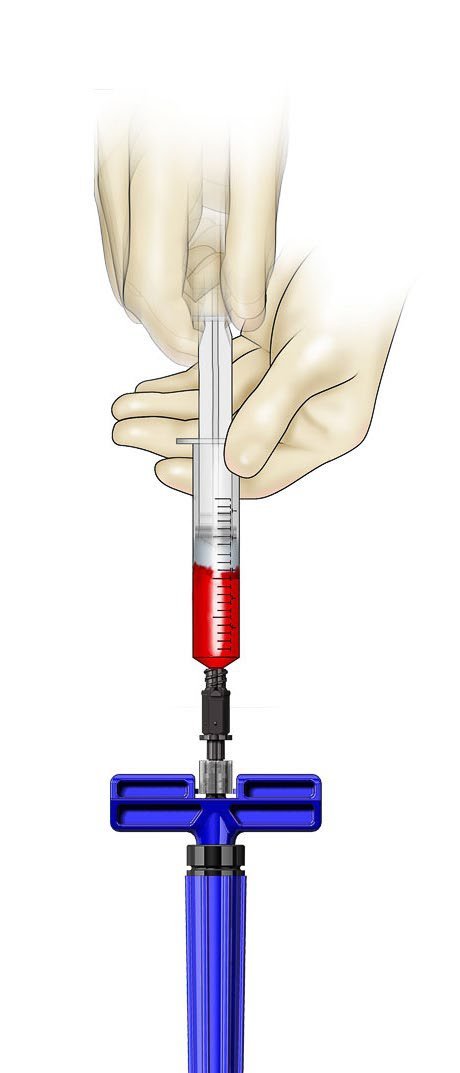 Marrow Cellution single-puncture aspiration, illustration