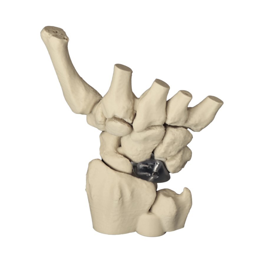 Custom-made implant in the lunate position of the proximal carpal row, seated on the distal radius, with the scaphoid to its radial side and the distal ulna alongside