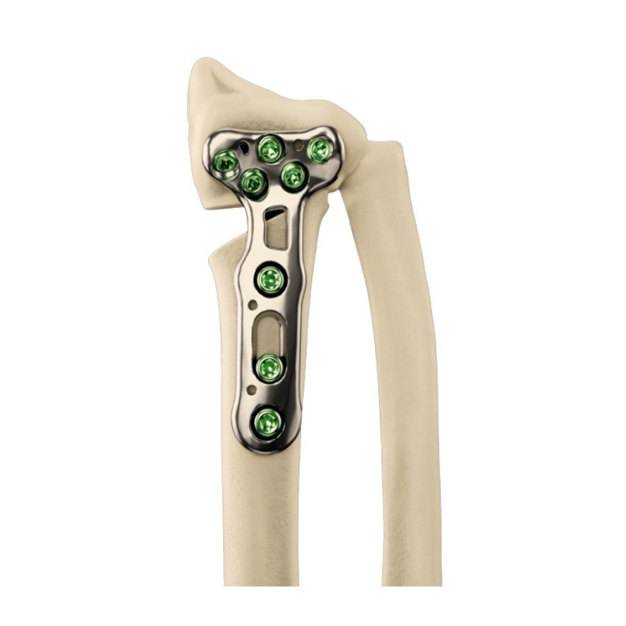 Contoured plate on the distal radius after a corrective osteotomy, fixed with locking screws, with the ulna and the distal radioulnar joint alongside