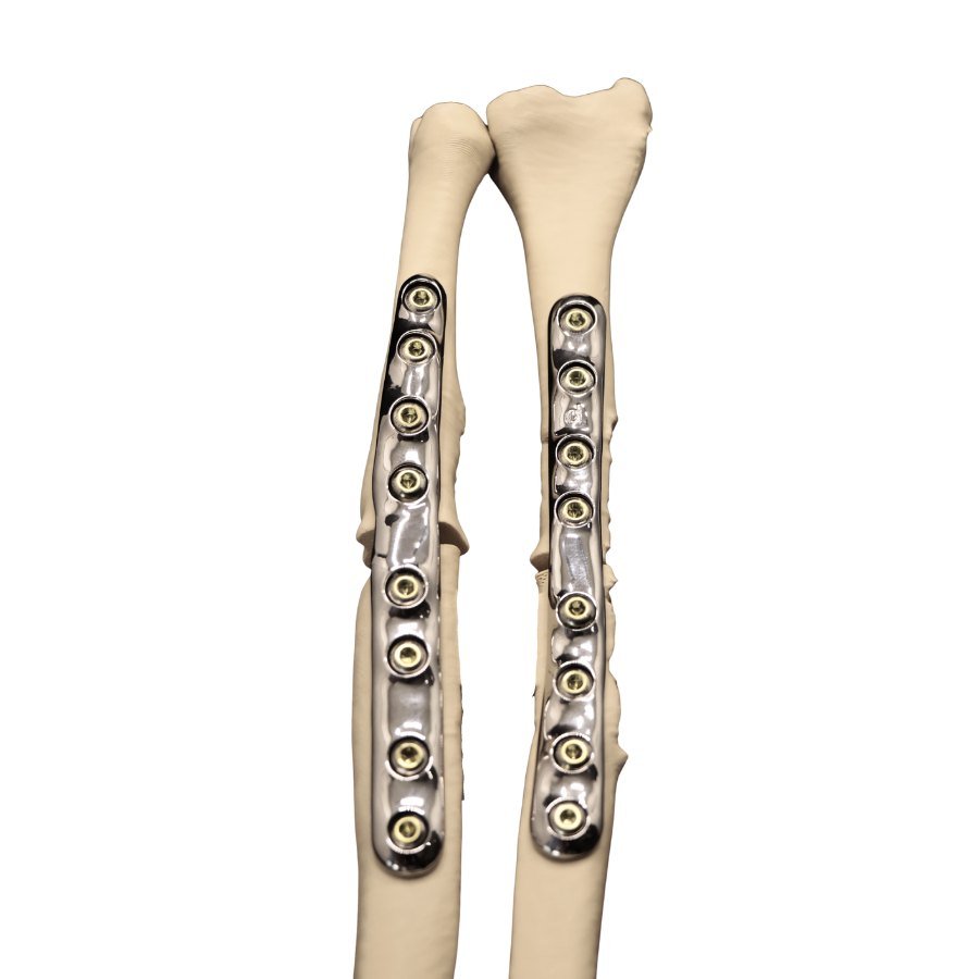 Custom-made plates on the radius and the ulna at mid-shaft, each fixed with locking screws