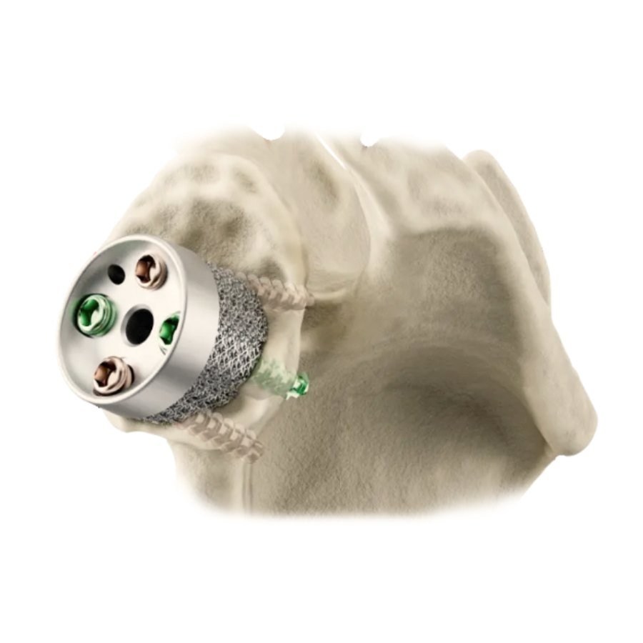 Custom-made glenoid component with a porous ingrowth surface, seated in the glenoid of the scapula and fixed with screws