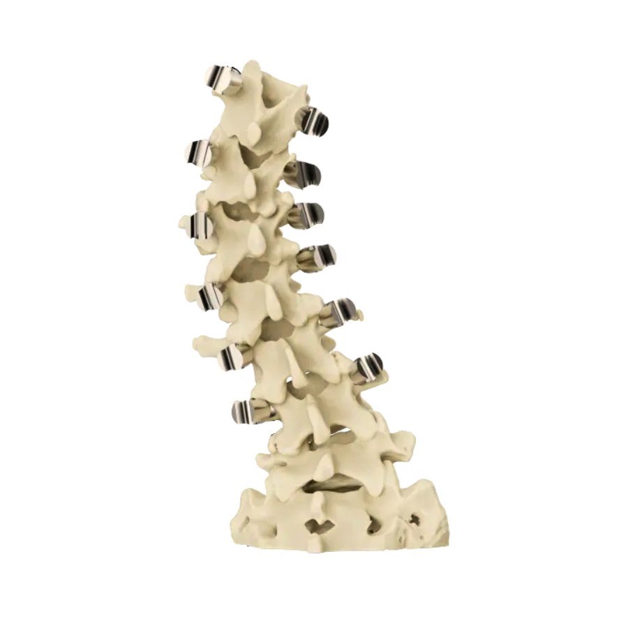 Patient-specific drill guides seated bilaterally on the posterior elements of consecutive vertebrae