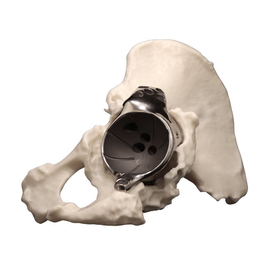 Custom-made acetabular component with an iliac flange, seated in the acetabulum of a hemipelvis, the obturator foramen below and the iliac wing above