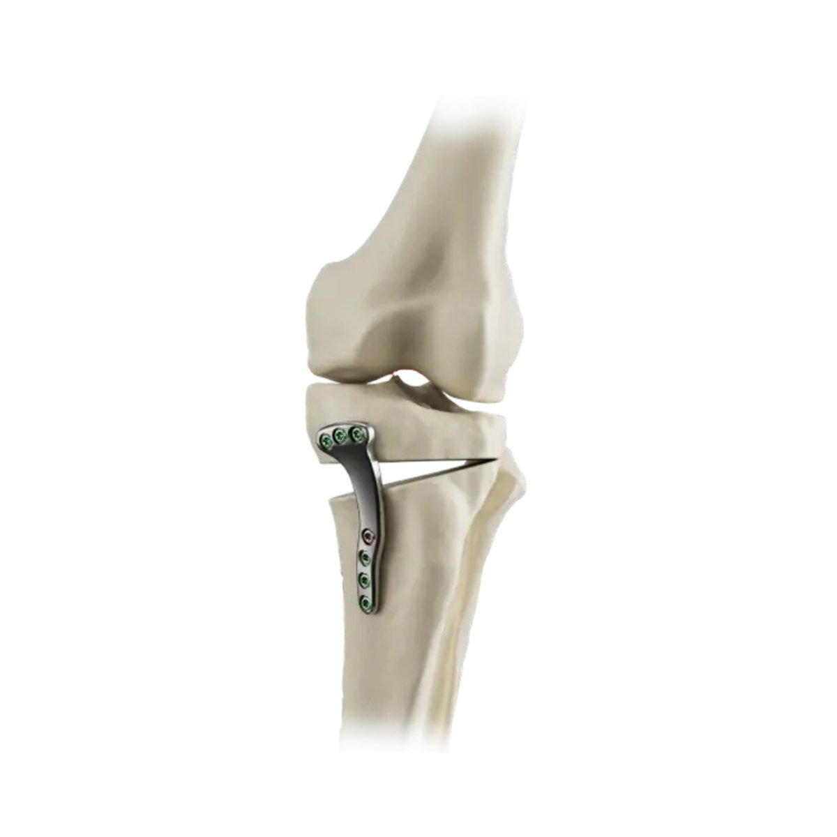 Medial opening-wedge high tibial osteotomy held open by a contoured plate, with locking screws above and below the wedge
