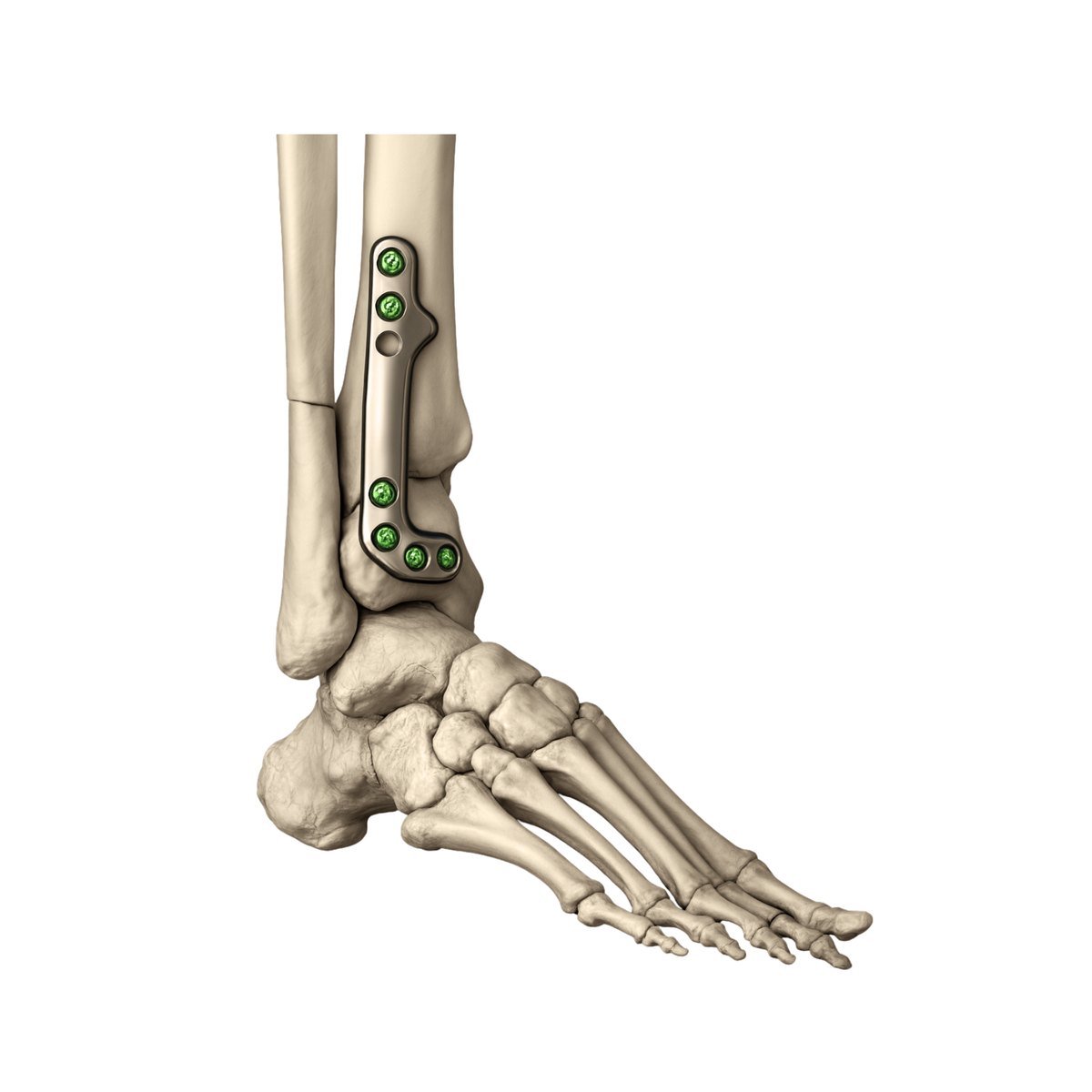 Contoured plate down the distal tibia and around the malleolus, fixed with locking screws, with the fibula alongside and the talus below