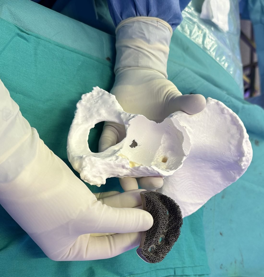 Custom-made porous titanium acetabular augment held against a 3D-printed model of the patient's hemipelvis in theatre
