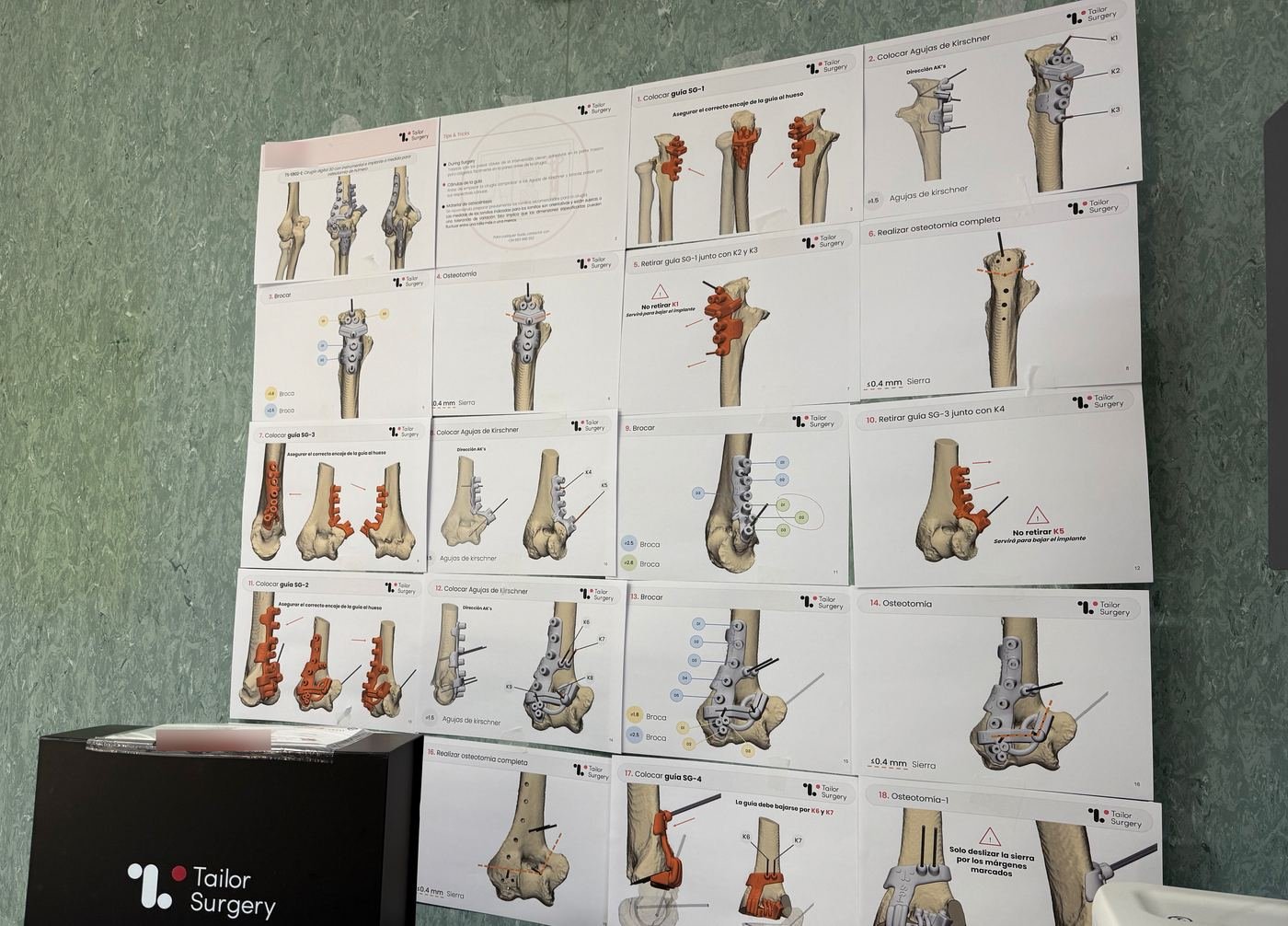 The step-by-step technique cards for a humerus osteotomy taped up in theatre, each card one stage of the guided procedure, with the single-use case box below