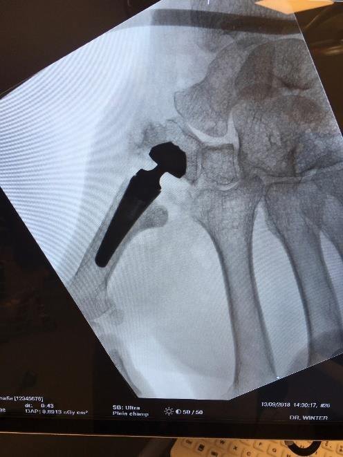 Touch CMC prosthesis, post-operative hand X-ray