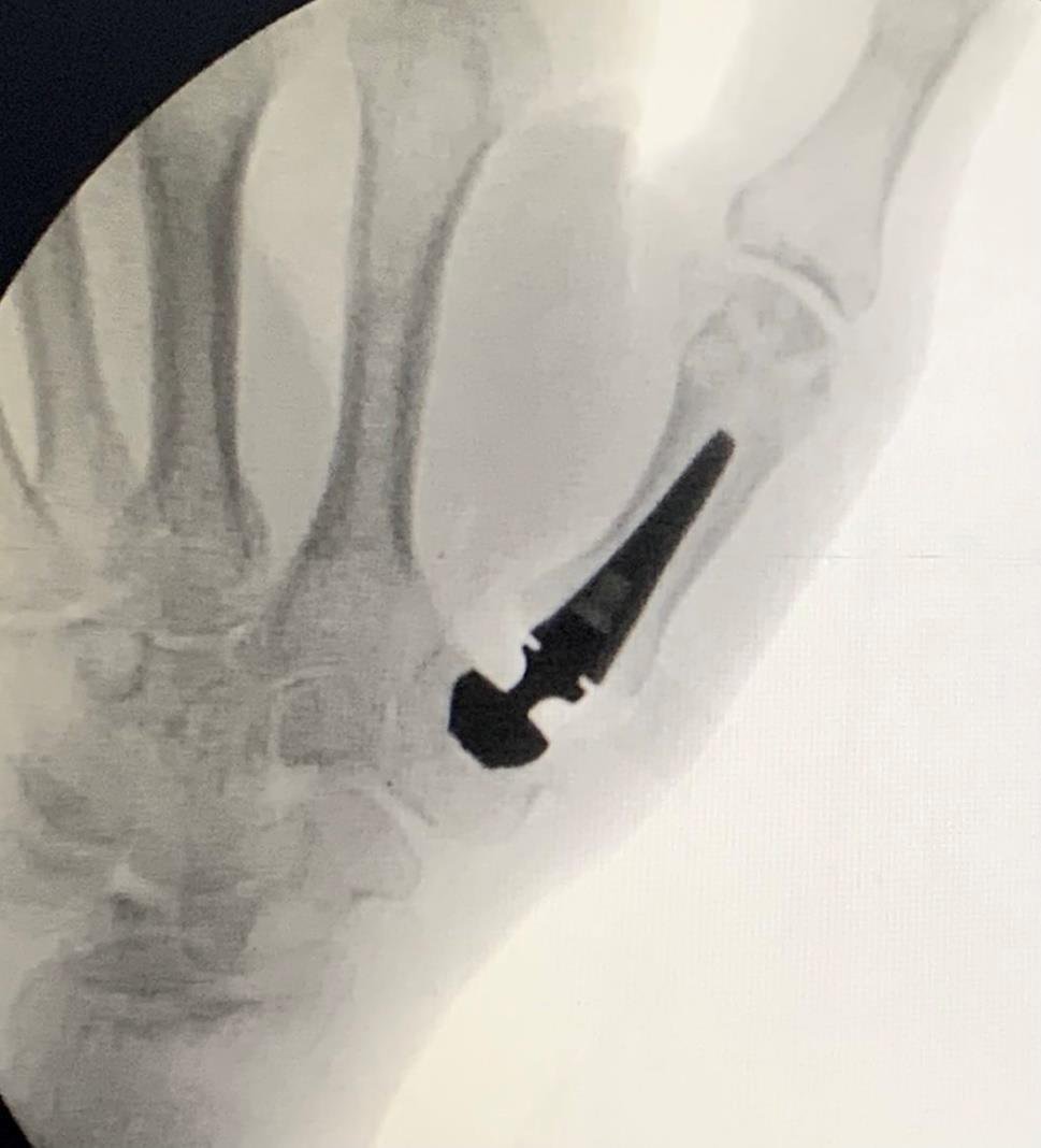 Touch CMC prosthesis stem in the metacarpal, post-operative X-ray