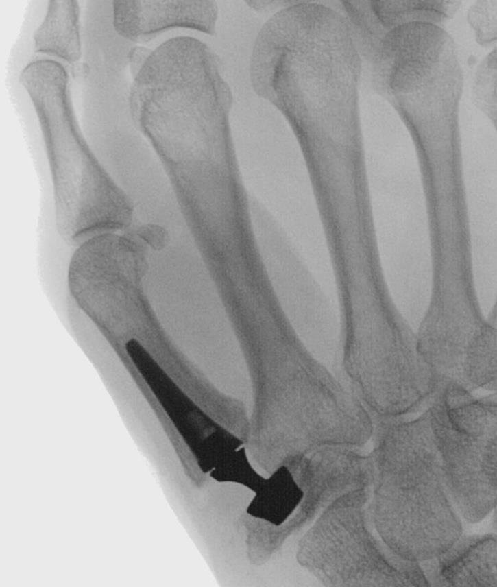 Touch CMC prosthesis, post-operative X-ray of the stem and cup