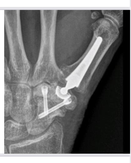 Touch CMC prosthesis, post-operative X-ray at the thumb base joint